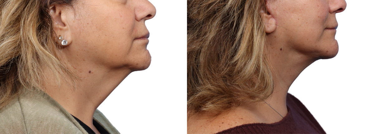 Deep Plane Facelift Before & After Gallery - Patient 836056 - Image 1