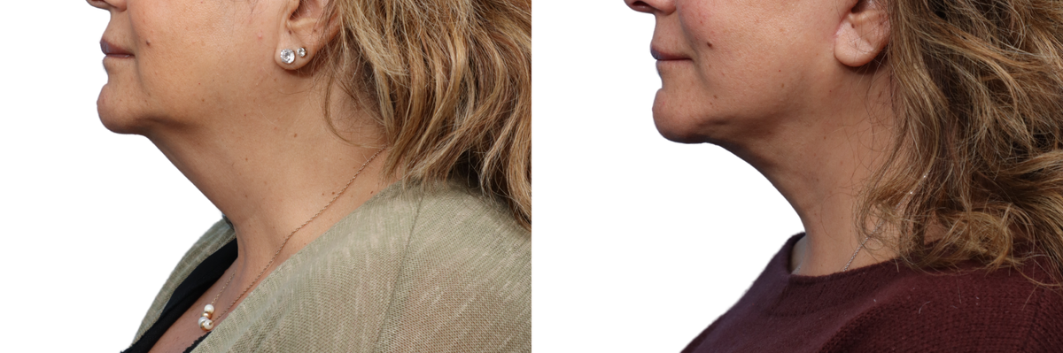 Deep Plane Facelift Before & After Gallery - Patient 836056 - Image 2