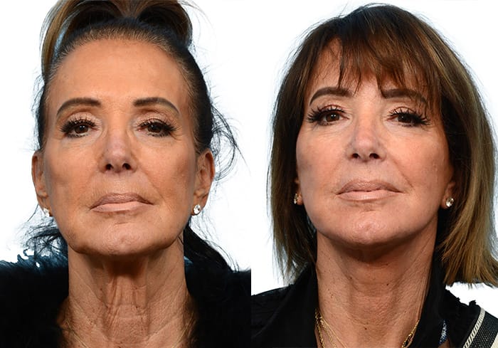 CO2 Laser before and after