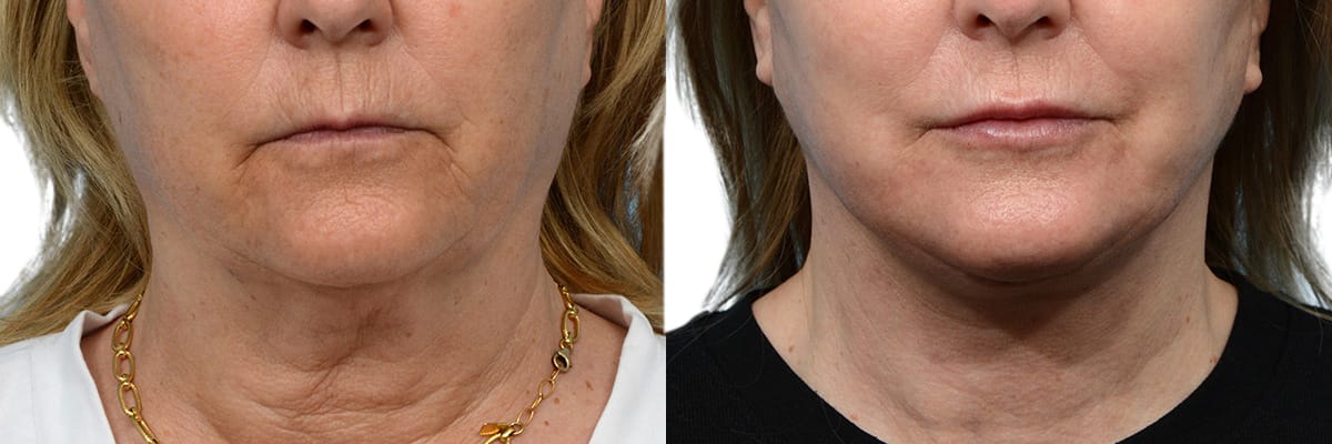 CO2 Laser before and after