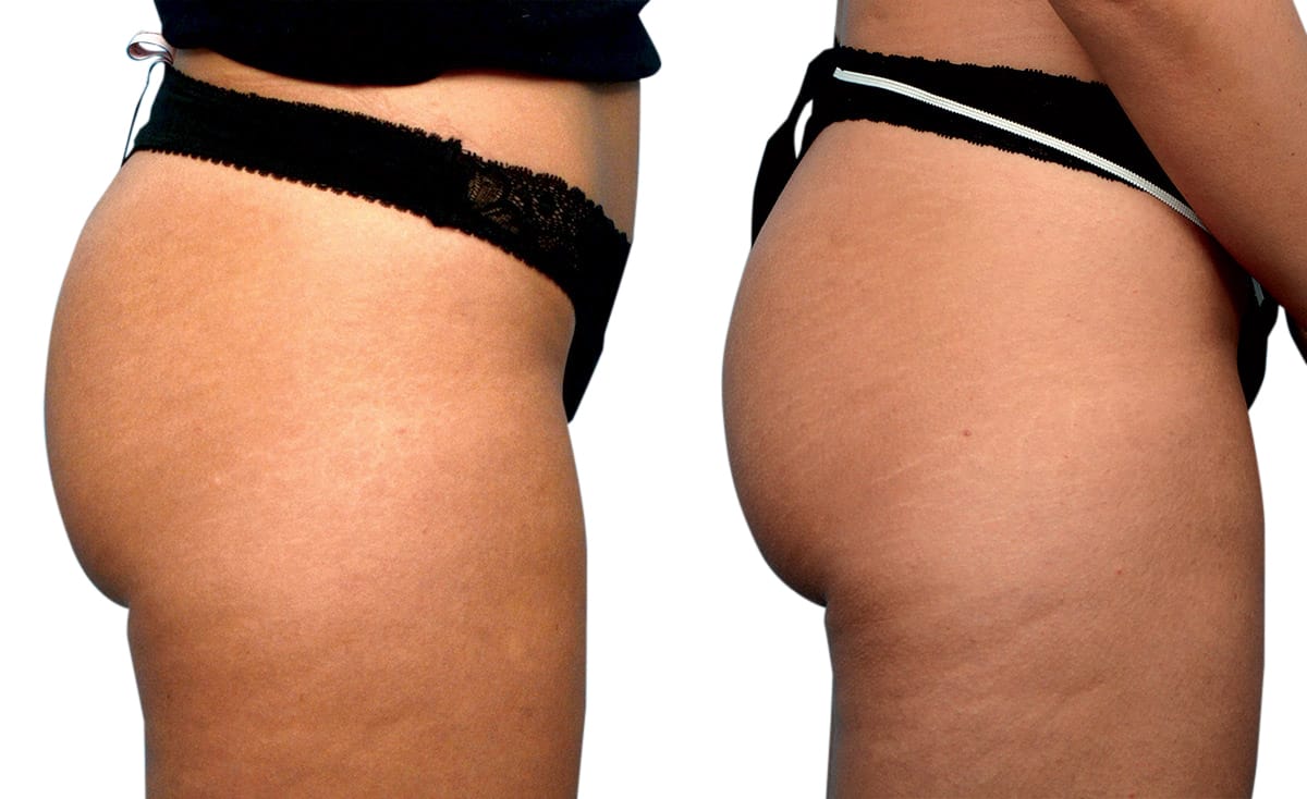 Emsculpt® Before & After Gallery - Patient 120504 - Image 1