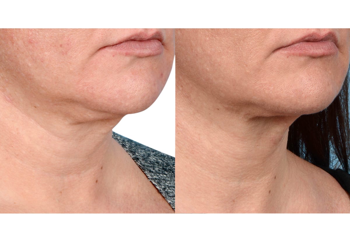Ultherapy before and after