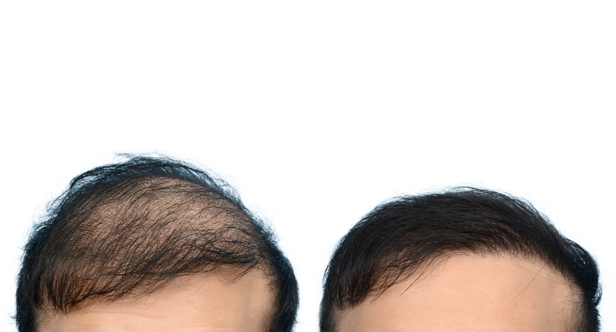 Hair Restoration before and after