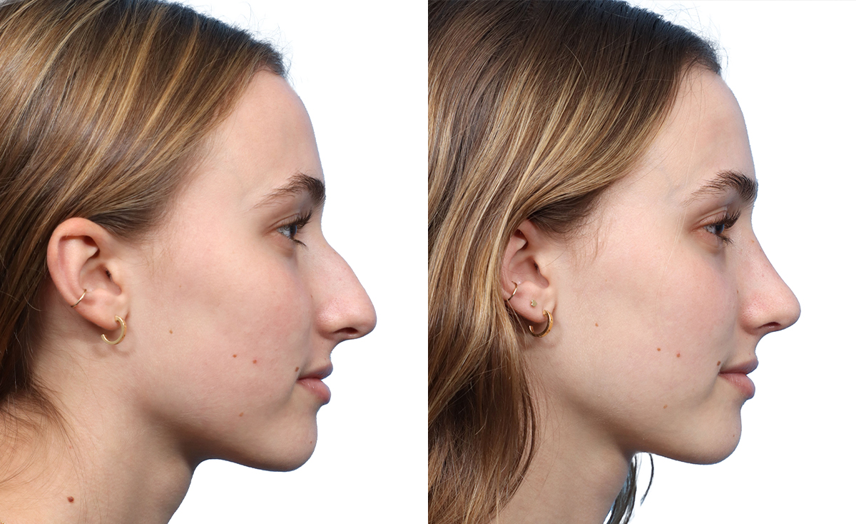 Rhinoplasty Before & After Gallery - Patient 327524 - Image 1