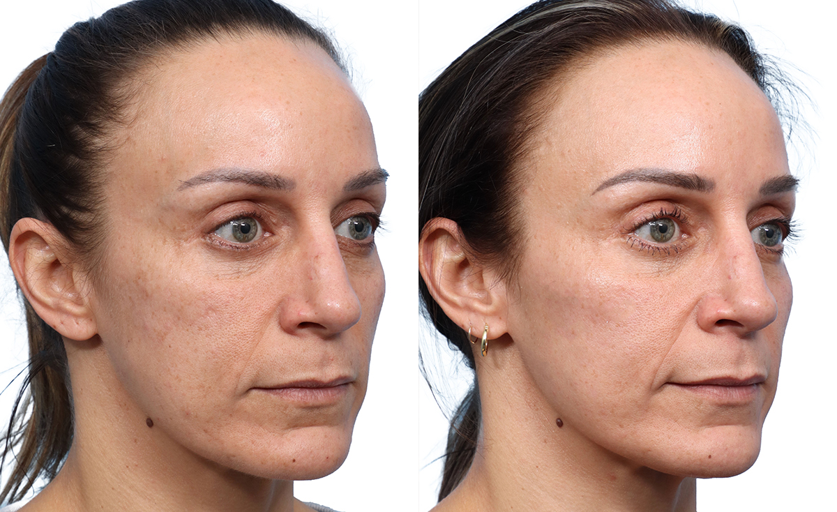 CoolPeel before and after