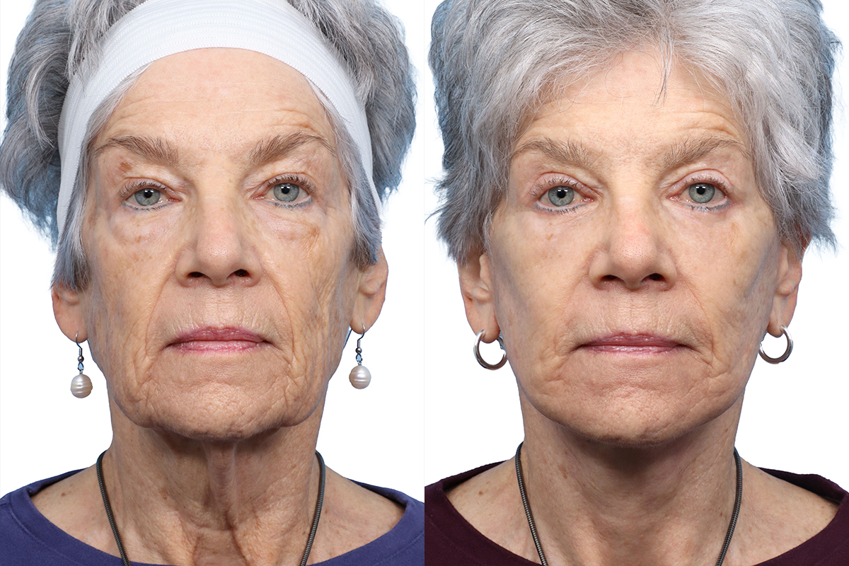 Deep Plane Facelift Before & After Gallery - Patient 199791 - Image 1