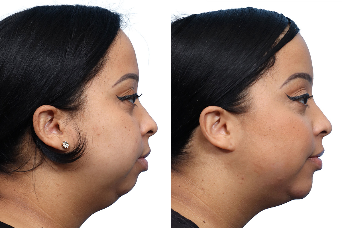 Chin Augmentation Before & After Gallery - Patient 359908 - Image 1