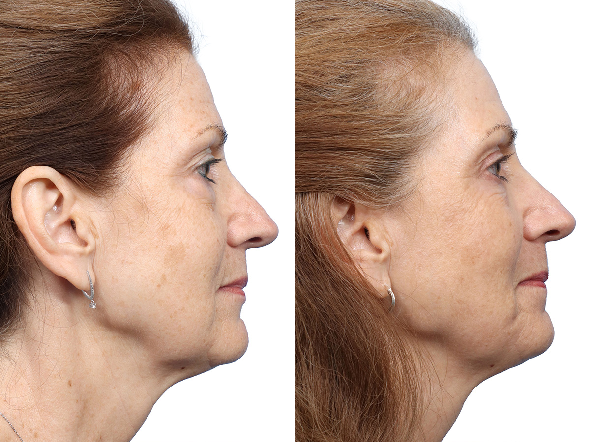 CO2 Laser before and after
