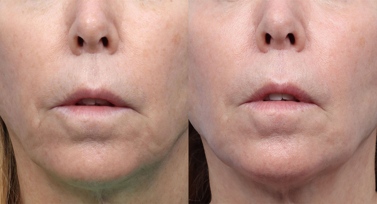 CoolPeel before and after