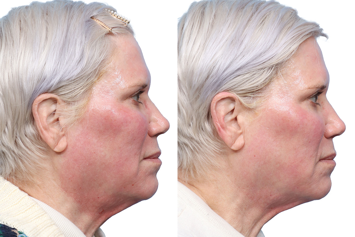 Glacial Skin Rx Before & After Gallery - Patient 281877 - Image 2