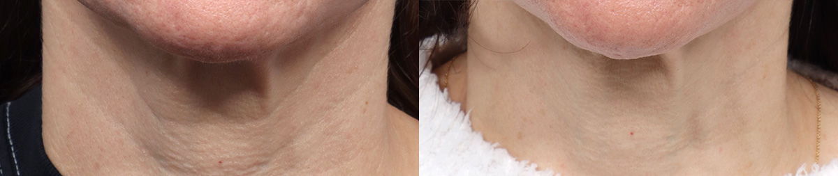 CoolPeel before and after