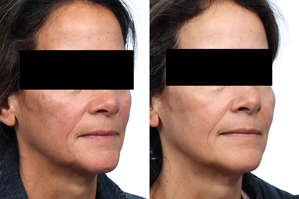 CoolPeel before and after