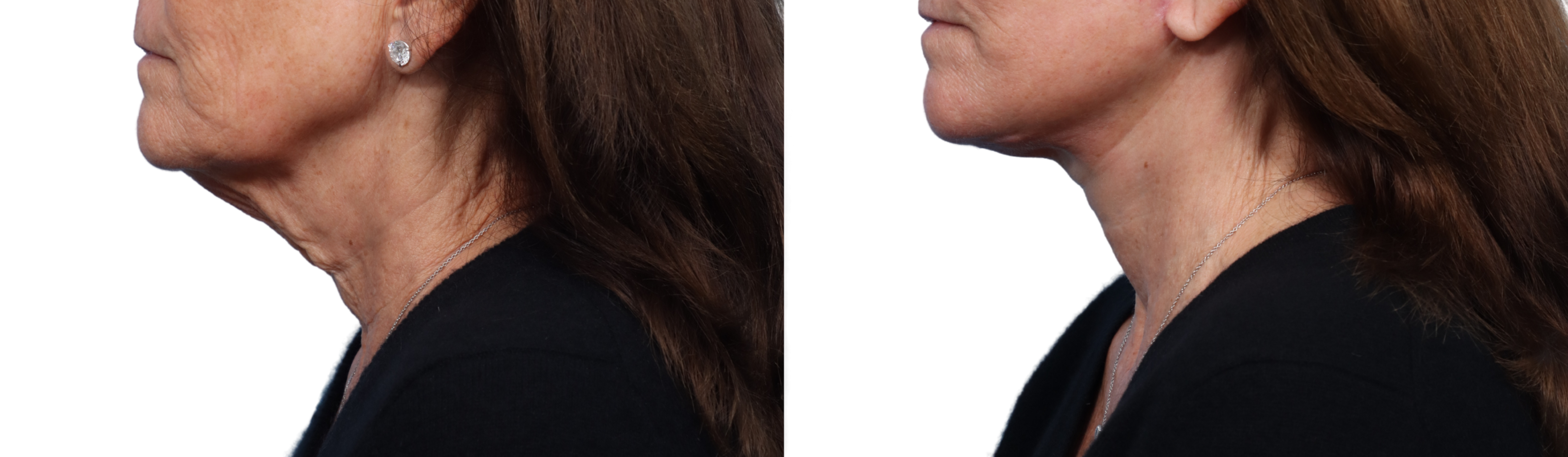 CO2 Laser Before & After Gallery - Patient 384191 - Image 2