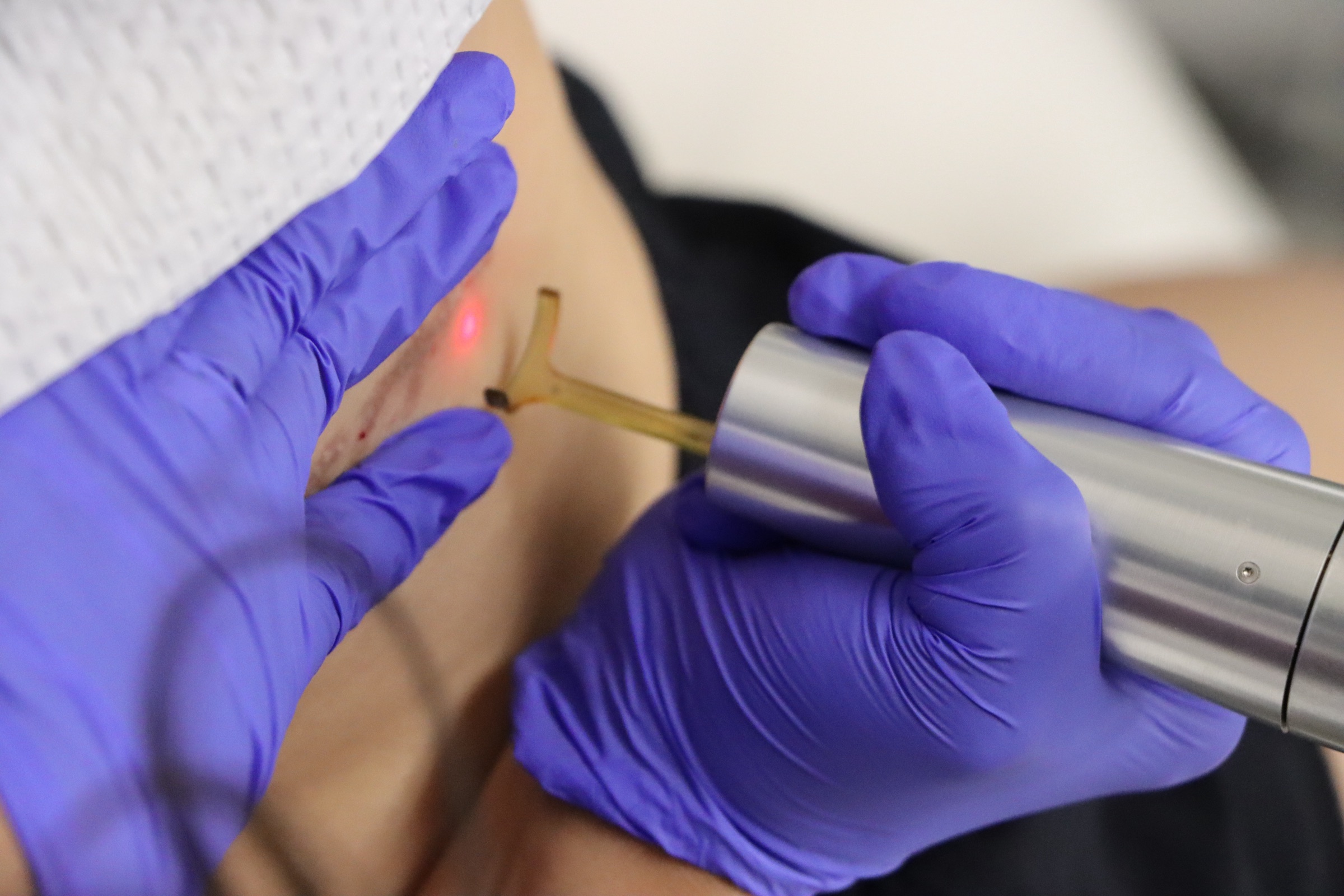Woman getting laser treatment