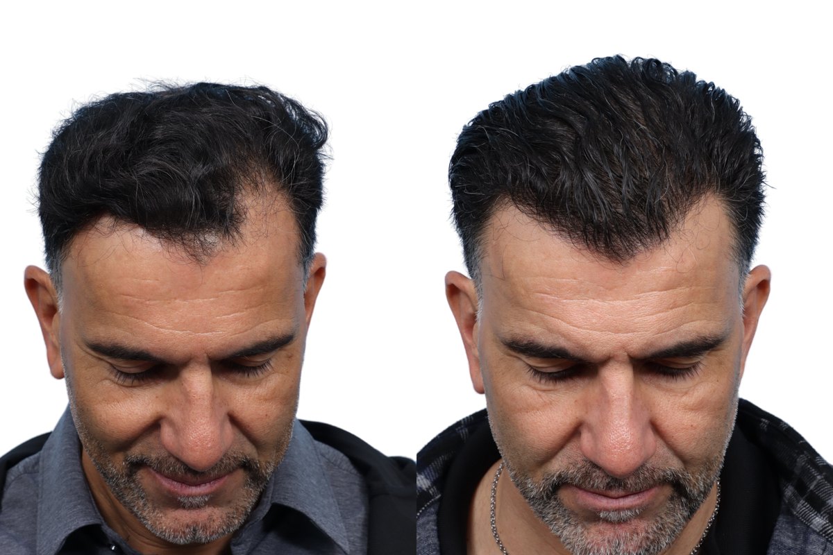 FUE Hair Transplant Before & After Gallery - Patient 892037