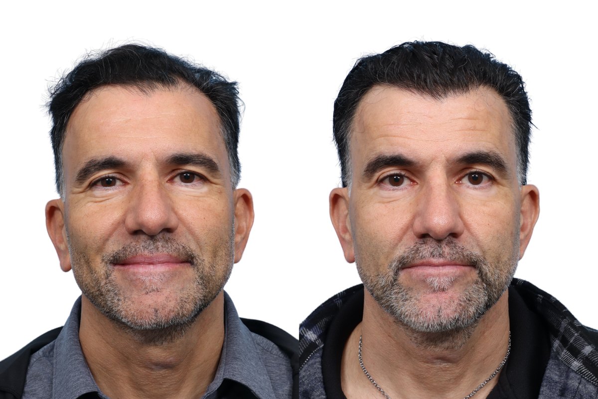 FUE Hair Transplant Before & After Gallery - Patient 892037 - Image 2