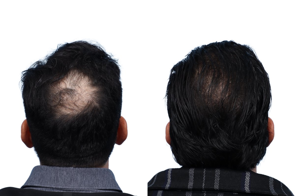 FUE Hair Transplant Before & After Gallery - Patient 892037 - Image 3