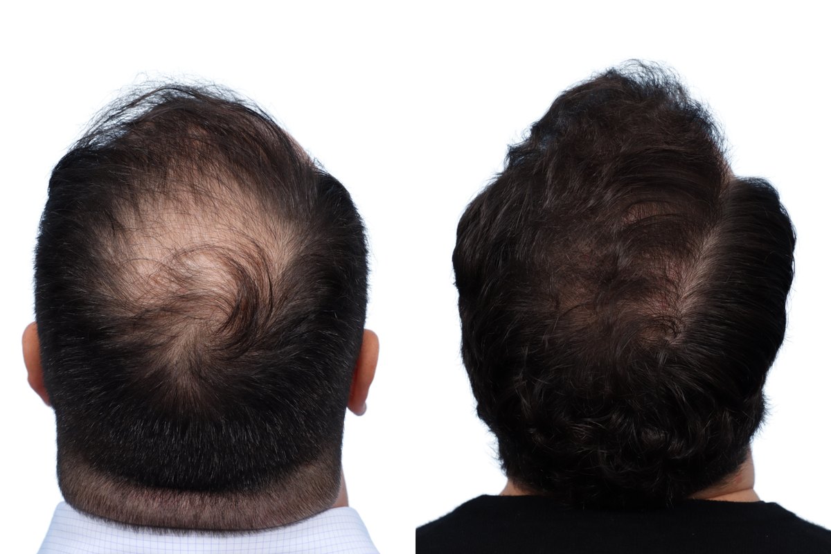 FUE Hair Transplant Before & After Gallery - Patient 645403