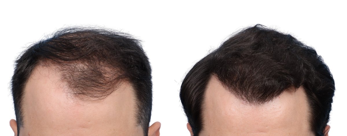 FUE Hair Transplant Before & After Gallery - Patient 645403 - Image 2