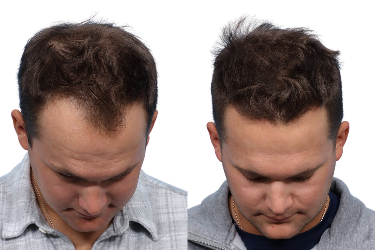FUE Hair Transplant Before & After Gallery - Patient 686465