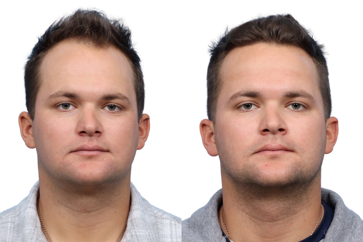 FUE Hair Transplant Before & After Gallery - Patient 686465 - Image 2