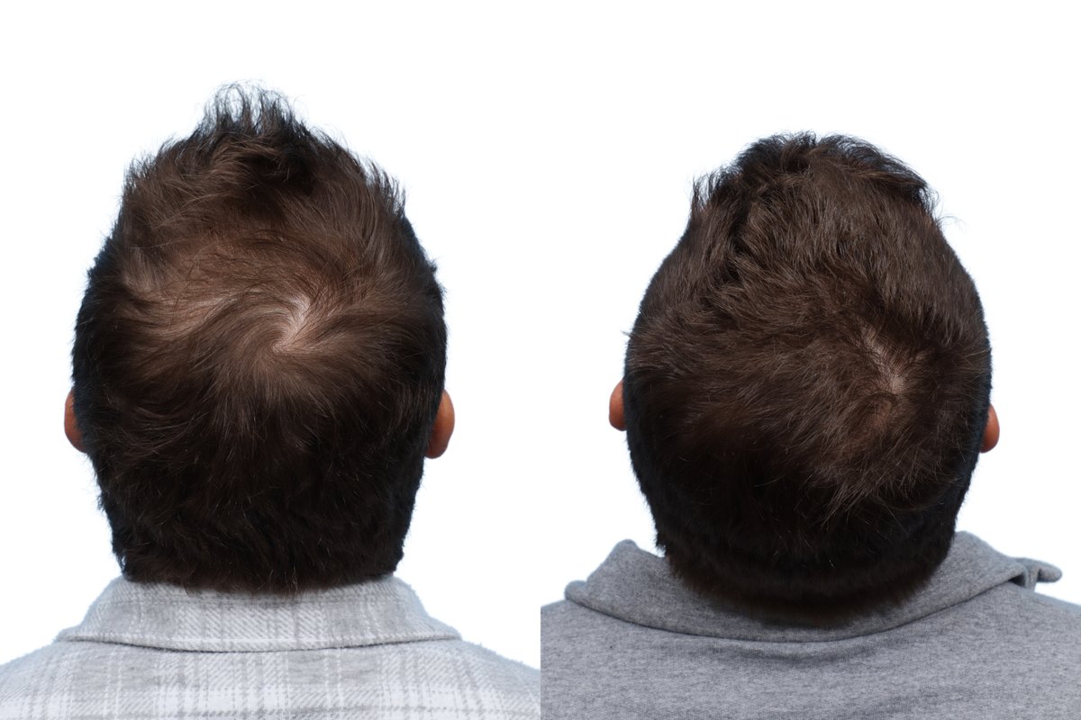 FUE Hair Transplant Before & After Gallery - Patient 686465 - Image 3