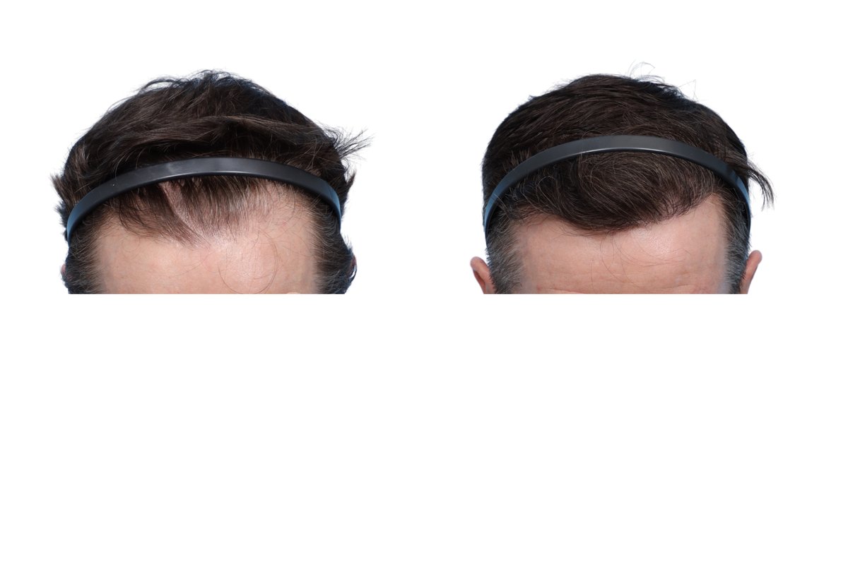 FUE Hair Transplant Before & After Gallery - Patient 844094