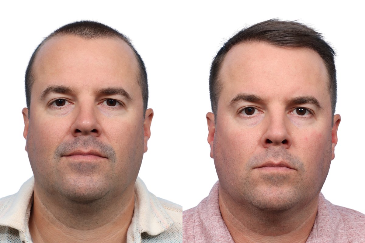 FUE Hair Transplant Before & After Gallery - Patient 486846