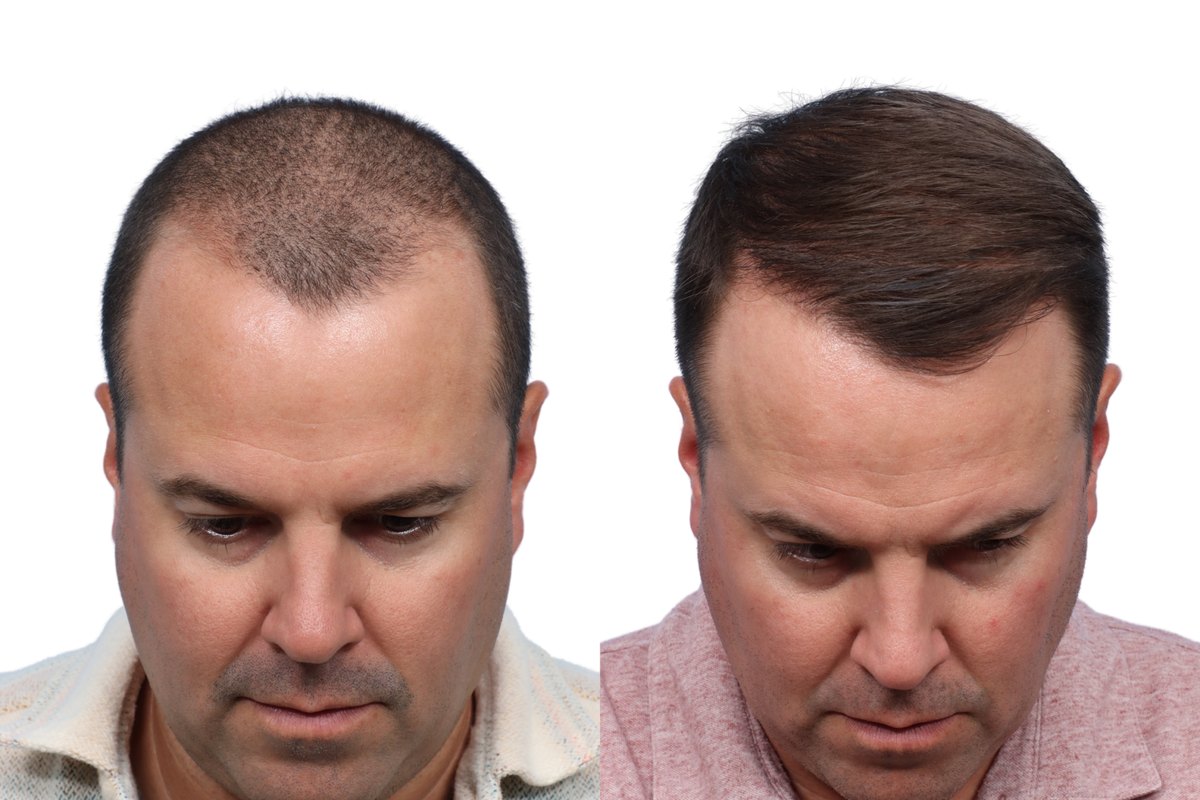 FUE Hair Transplant Before & After Gallery - Patient 486846 - Image 2