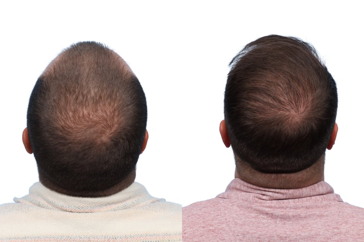 FUE Hair Transplant Before & After Gallery - Patient 486846 - Image 3