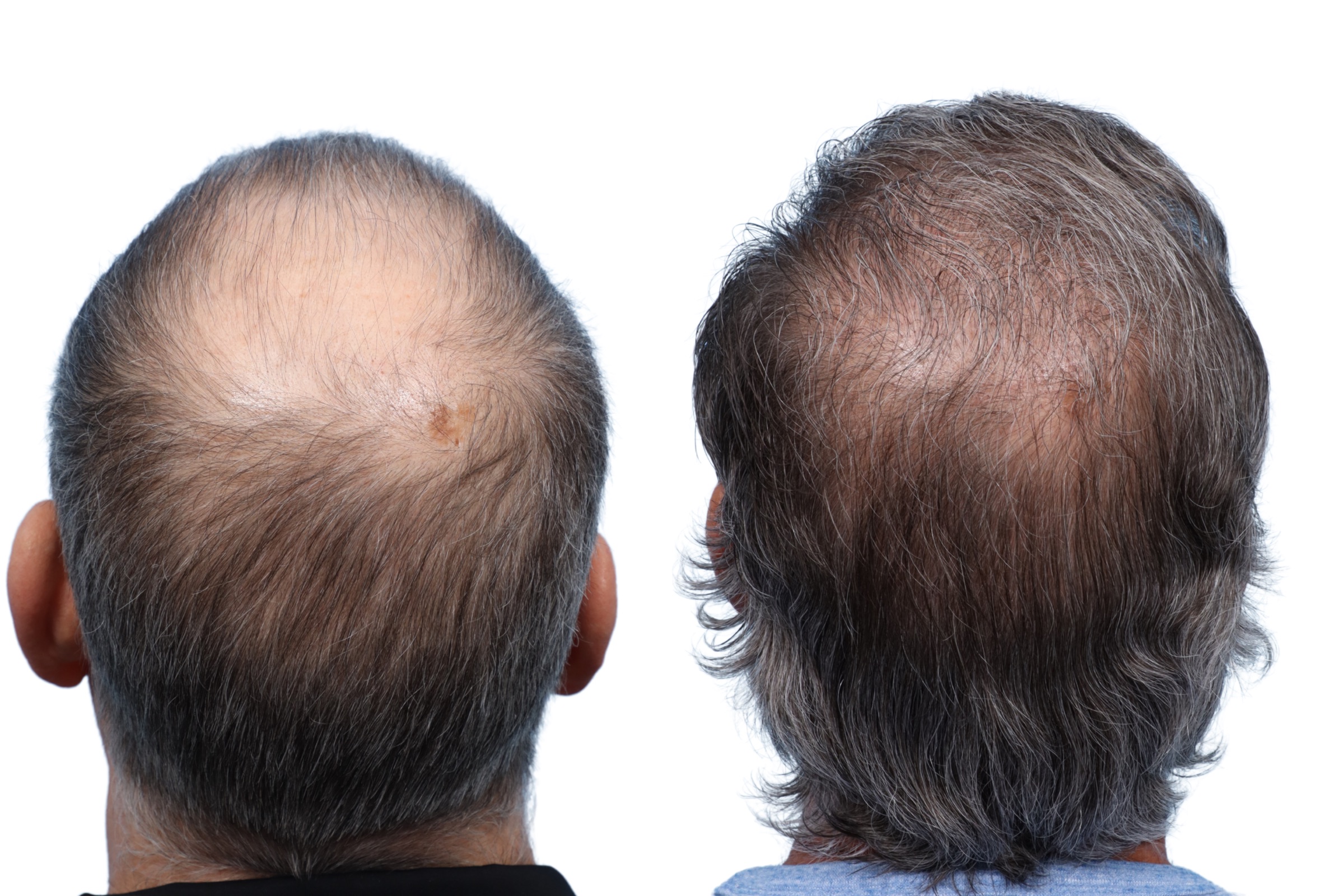 FUE Hair Transplant Before & After Gallery - Patient 534127 - Image 3