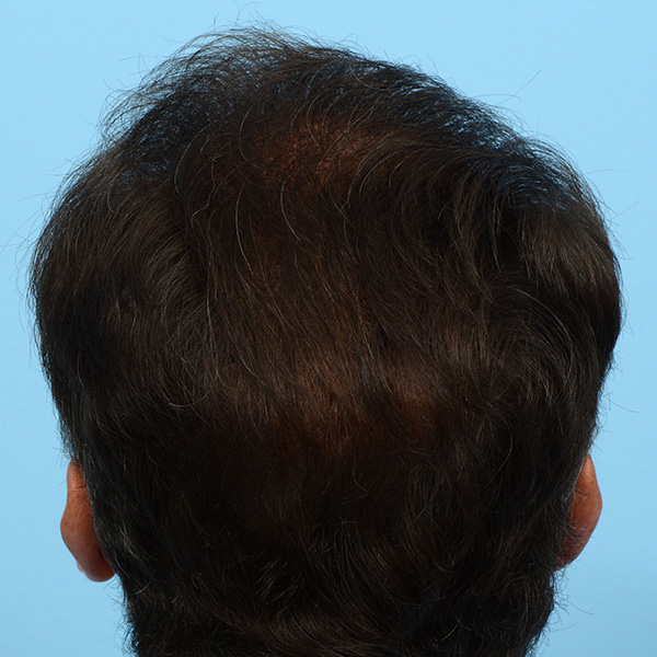 Fue Before and After | Dr. Jeffrey Wise