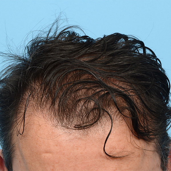 Fue Before and After | Dr. Jeffrey Wise
