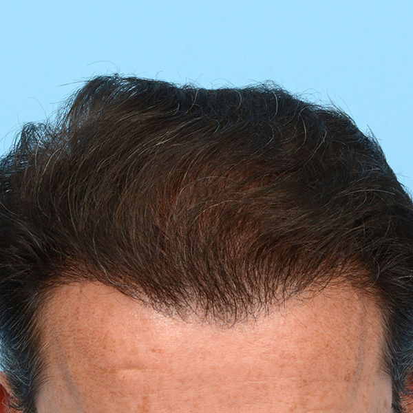 Fue Before and After | Dr. Jeffrey Wise