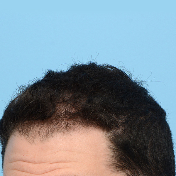 Fue Before and After | Dr. Jeffrey Wise