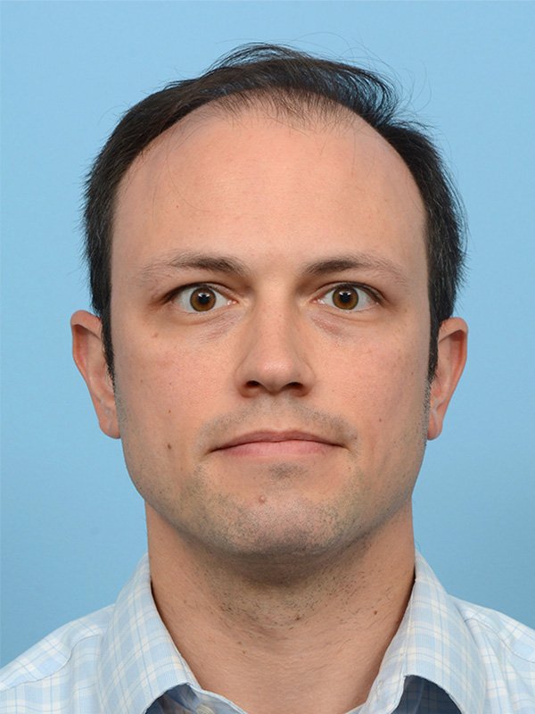 Fue Before and After | Dr. Jeffrey Wise