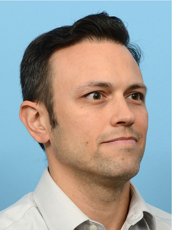 Fue Before and After | Dr. Jeffrey Wise