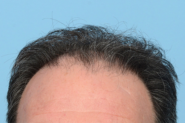 Follicular Unit Extraction (FUE) hair restoration — Patient 171 photo 1