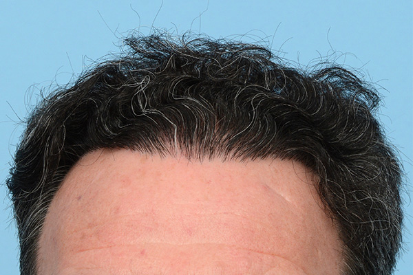 Follicular Unit Extraction (FUE) hair restoration — Patient 171 photo 2