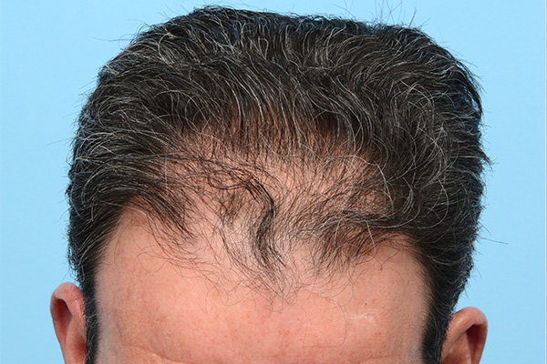 Follicular Unit Extraction (FUE) hair restoration — Patient 171 photo 3