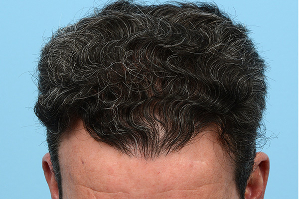 Follicular Unit Extraction (FUE) hair restoration — Patient 171 photo 4
