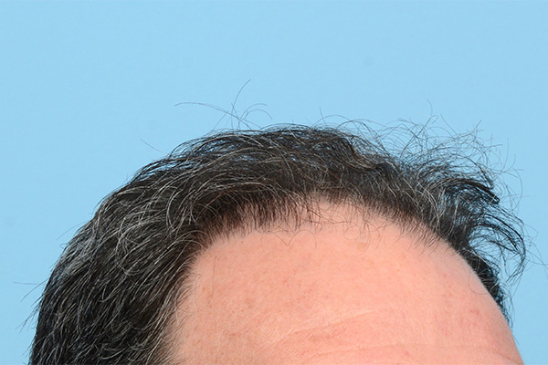 Follicular Unit Extraction (FUE) hair restoration — Patient 171 photo 5