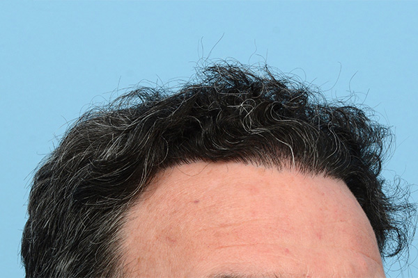 Follicular Unit Extraction (FUE) hair restoration — Patient 171 photo 6