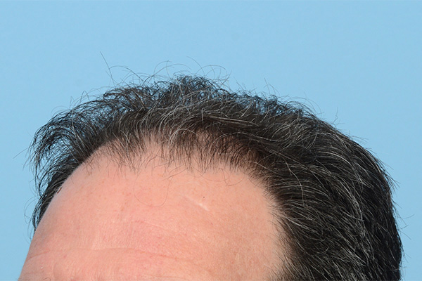 Follicular Unit Extraction (FUE) hair restoration — Patient 171 photo 7
