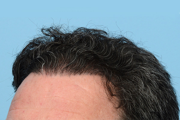 Follicular Unit Extraction (FUE) hair restoration — Patient 171 photo 8