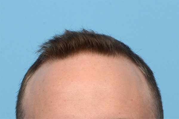 Follicular Unit Extraction (FUE) hair restoration — Patient 173 photo 1