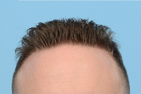 Follicular Unit Extraction (FUE) hair restoration — Patient 173 photo 2