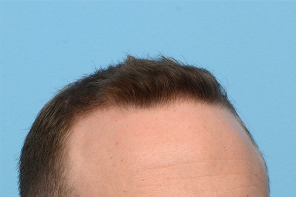 Follicular Unit Extraction (FUE) hair restoration — Patient 173 photo 3
