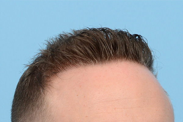 Follicular Unit Extraction (FUE) hair restoration — Patient 173 photo 4
