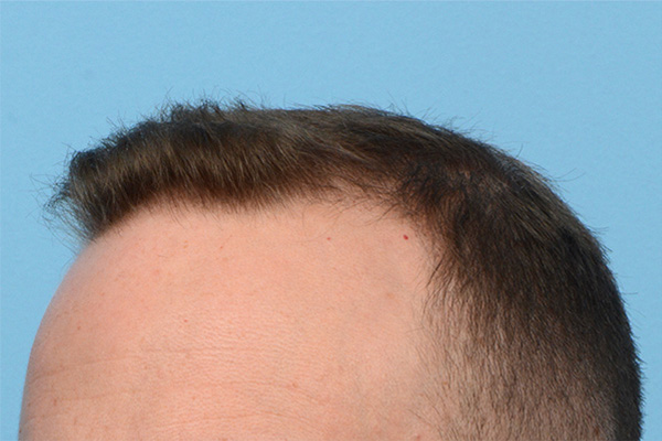 Follicular Unit Extraction (FUE) hair restoration — Patient 173 photo 5